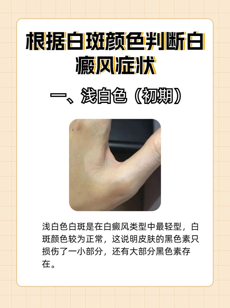 在寻找最好的白癜风治疗方法时,许多人将目光投向了“国丹袪白”。今天我们就来聊聊这种疗法及其可靠性。