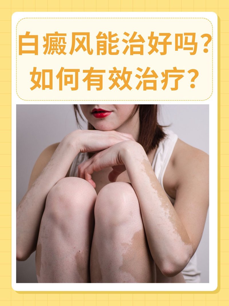 白斑治疗有哪些方法?选择最合适的方案